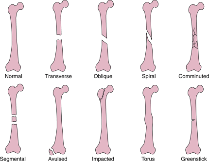 Có những kiểu gãy xương nào trong chấn thương?